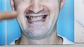 جراحی ارتوگناتیک بایمکس و جنیو