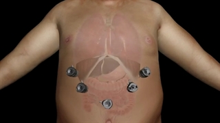 جراحی چاقی به روش اسلیو معده