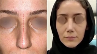 یک ماه بعد از جراحی زیبایی بینی استخوانی