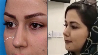 جراحی اولیه بینی با نوک غضروفی