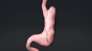 در روند عمل اسلیو معده چه اتفاقاتی می‌افتد؟