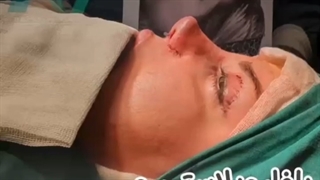 رینوبلفاروپلاستی