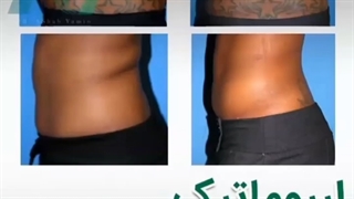 لیپوماتیک شکم و پهلو