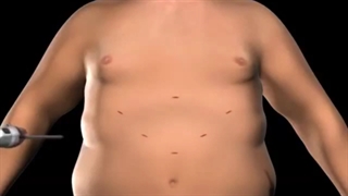 عمل جراحی اسلیو به روش لاپاراسکوپی