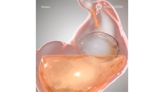 روش بالون معده چگونه انجام می‌شود و چگونه باعث کاهش وزن می‌گردد؟