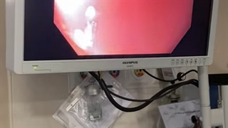 فیلم بوتاکس معده در ایران