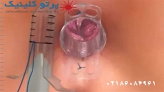 فیلم جراحی هموروئید با استاپلر