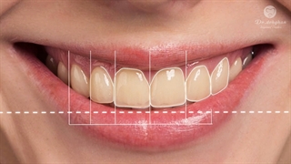 لبخند زیبا با ایمپلنت : دکتر دهقان