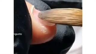 کاشت ناخن جویده شده