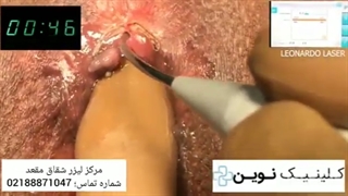 فیلم عمل و درمان شقاق با لیزر در کلینیک نوین