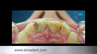 آمالکپ چیست ؟ - سبحان دنتال