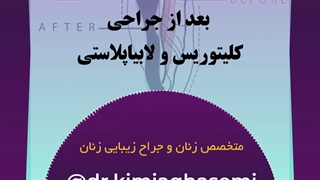 رضایتمندی مراجعه کننده از جراحی لابیاپلاستی به همراه هودکلیتوریس