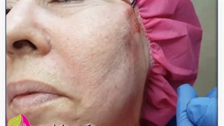 لیفت صورت با نخ