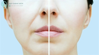 برطرف کردن خط خنده به روش دائمی