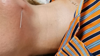 از بین بردن غبغب با طب سوزنی