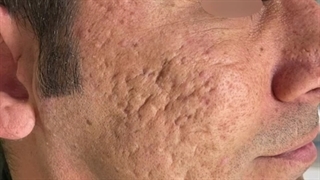 رفع قطعی جای جوش و اکنه