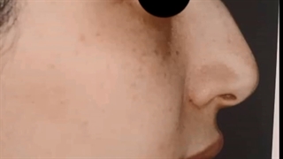 عمل جراحی بینی قوزدار