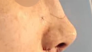 فیلم جراحی بینی(رینوپلاستی) در اتاق عمل