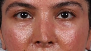 مراجعه کننده عزیزمون به ترتیب یک هفته قبل و یک هفته بعد از عمل ترمیم بینیشون