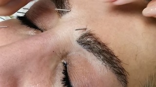 از بین بردن خط اخم با طب سوزنی