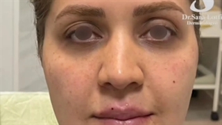 جوانسازی با یک جلسه