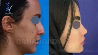جراحی زیبایی بینی