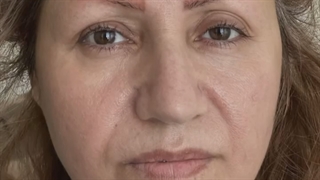 کاشت مو در هر سنی