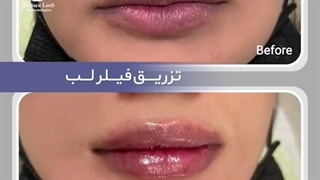 لب های برجسته و طبیعی فقط...