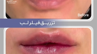 لبهای برجسته میخوای؟