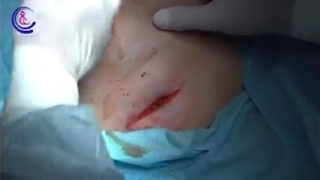 فیلم جراحی سینه در خانم مسن