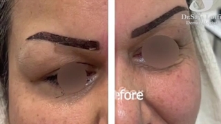 ترمیم بینی بدون جراحی