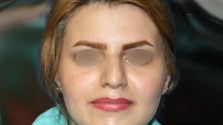 نمونه کار قبل و بعد جراحی بینی