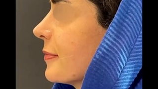 زیبایی چهره با جراحی طبیعی بینی