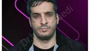 نمونه کار قبل و بعد جراحی بینی