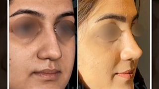 نمونه هایی از جراحی زیبایی بینی برای مراجعه کنندگان عزیز