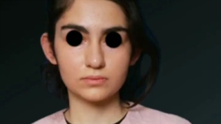 نمونه کار قبل و بعد جراحی بینی ترمیمی