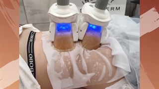 کرایولیپولیز چیه؟