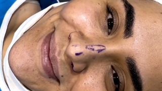 دختر خوشگلمون مریم خانوم جراحی کامل بینی با بی حسی و در مطب داشتند