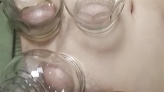 بادکش درمانی