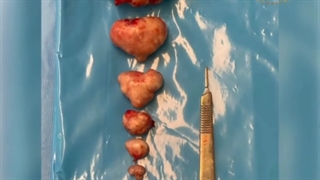 جراحی فیبروم رحمی مراجعه کننده 