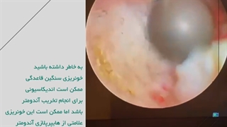 آیا درباره تخریب آندومتریوز چیزی میدونید ؟ ⬆️