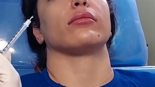 مراقبت های بعد تزریق بوتاکس لیزر مو