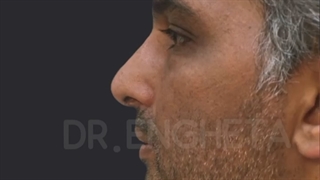 ❌❌چانه نقش مهمی در تناسب صورت و زیبایی داره که معمولا از اون غافلیم !