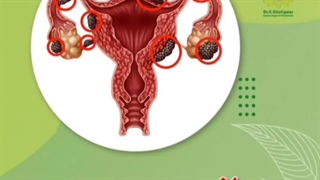 اندومتریوز چه علائمی داره