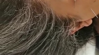 جوانسازی با طب سوزنی