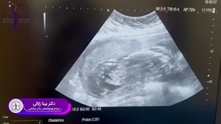 سونوگرافی جنین 5 ماهه