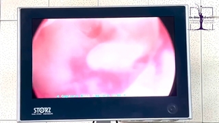 خروج پولیپ رحم با هیستروسکوپی