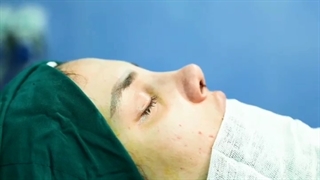 جراحی بینی با قوس ملایم دلخواه 