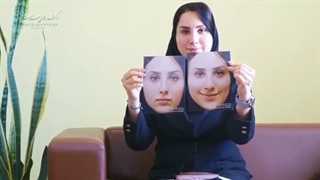 شش ماه بعد از جراحی بینی