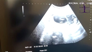 سونوگرافی 4 قلوها